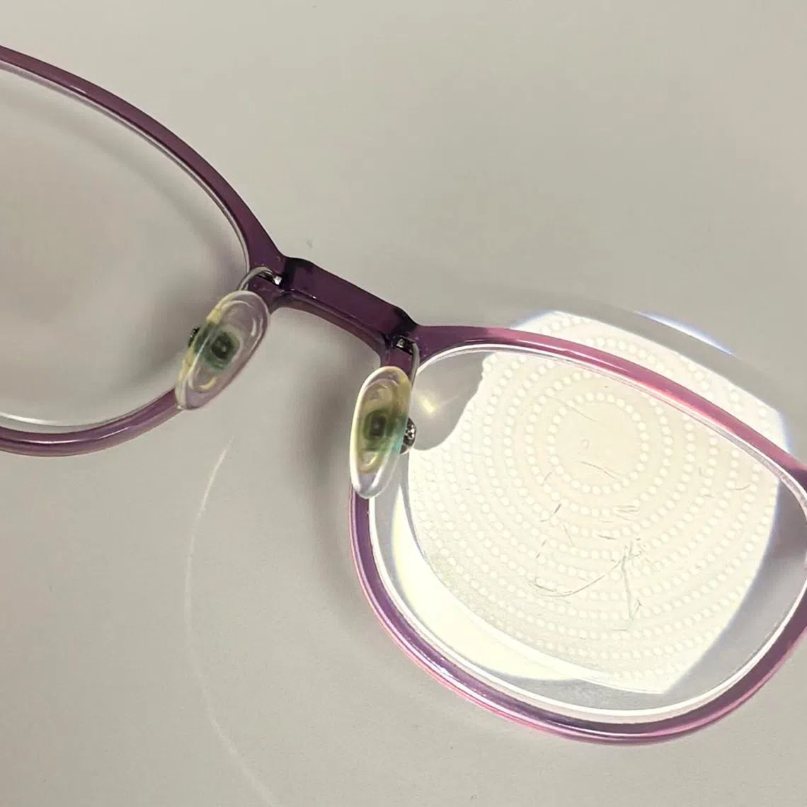 Children with high myopia face an increased risk of eye diseases such as cataracts and glaucoma in adulthood.