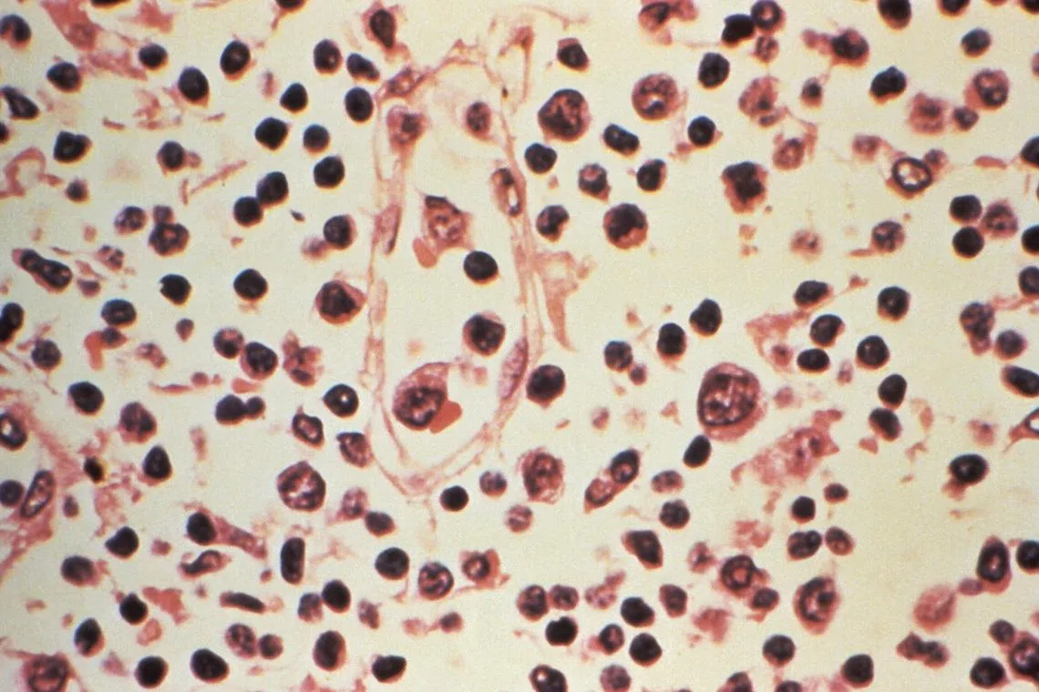 FILE PHOTO: Some of the cytoarchitectural features in a lymph node specimen extracted from a patient suspected of a Hantavirus illness is seen in this handout photo obtained by Reuters, July 6, 2017.  Centers for Disease Control and Prevention/Handout via REUTERS/File Photo