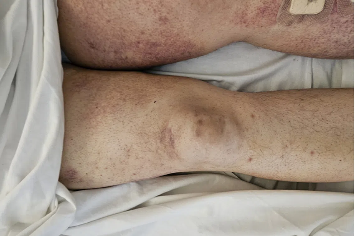 Doctors found tiny painful red-brown pinpoints, resembling a rash, on the man’s legs.