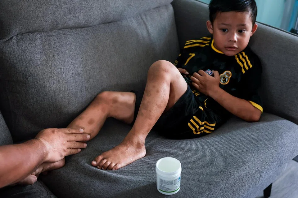 Faris Zafran, 5, who has severe eczema, having moisturiser applied on his legs by his father in their home in Pasir Ris on Dec 7, 2024.
