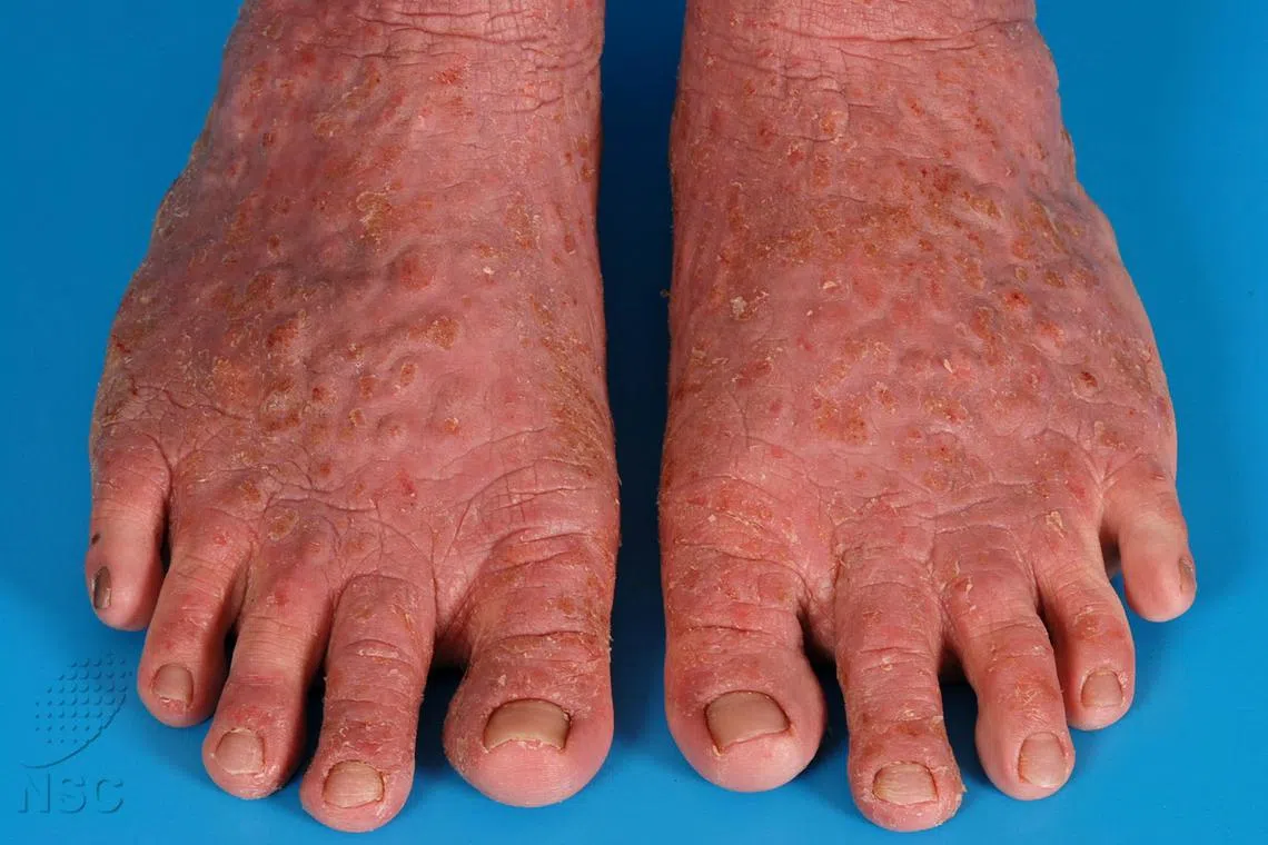 jteczema - Feet of patient suffering from severe eczema 

Source: National Skin Centre