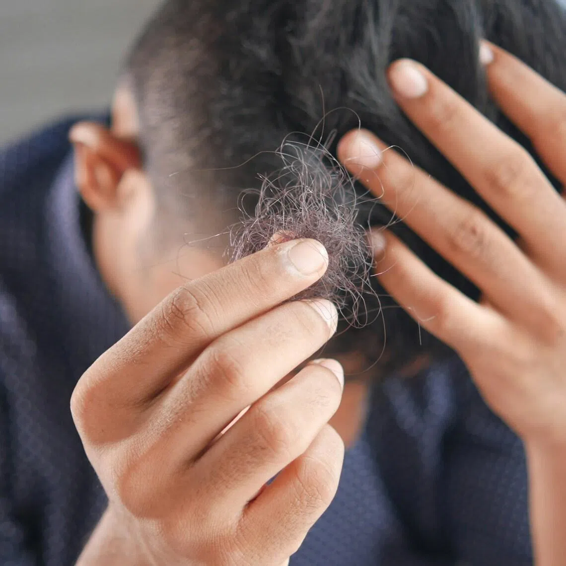 The debate centres on whether male-pattern hair loss, a common form of androgenetic alopecia, should be covered by the country’s public health insurance system.
