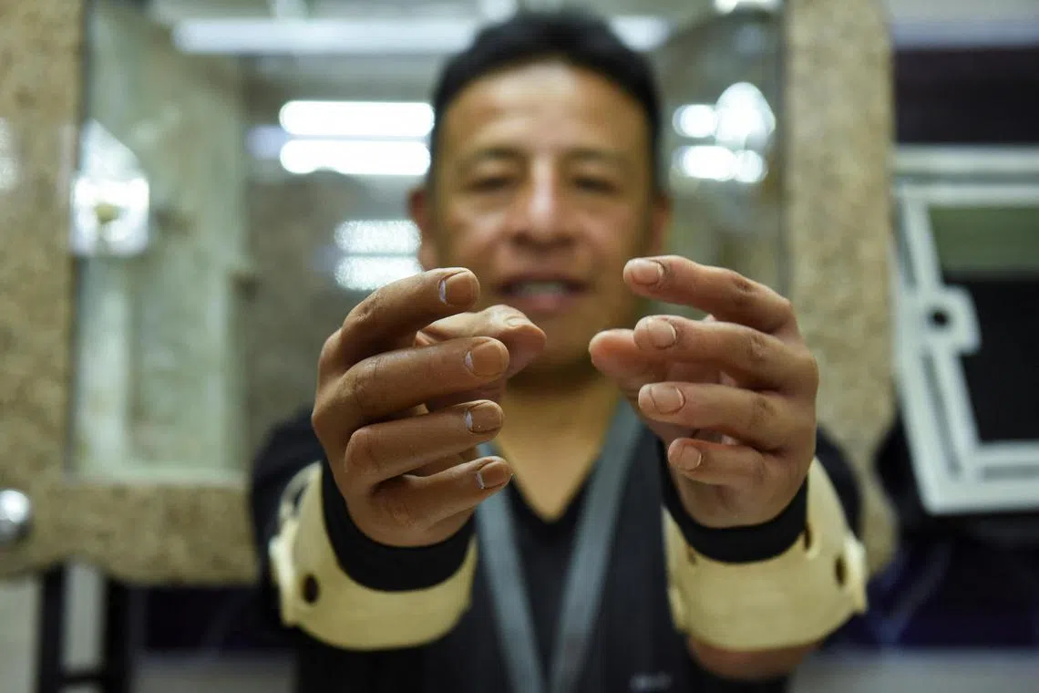 Mr Rirchard Vargas now wears two hyper-realistic prosthetic hands which allow him to walk around unnoticed, write, eat using cutlery and do much more.
