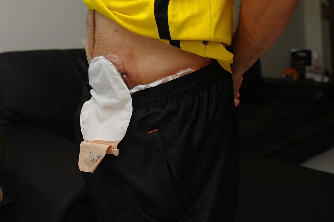 Moving forward, we need ro talk more openly about stomas to help patients feel less isolated, writes a nurse.