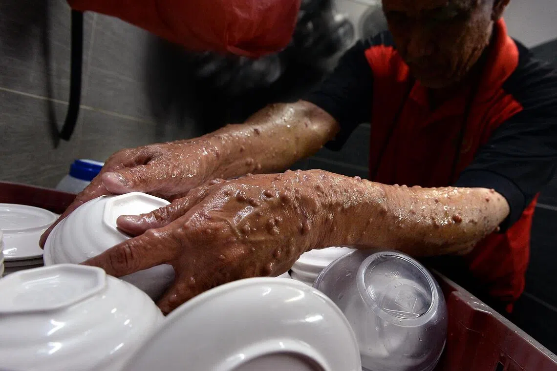 Neurofibromatosis sometimes manifests itself as growth of thousands of benign tumours on the body and face, causing stigma and misunderstandings.