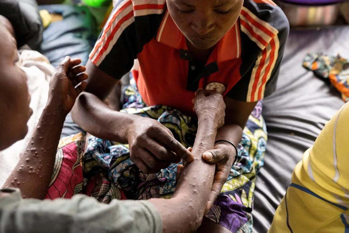 A woman pricking the rashes of her sister to relieve the pain of an mpox infection, in the Democratic Republic of Congo.