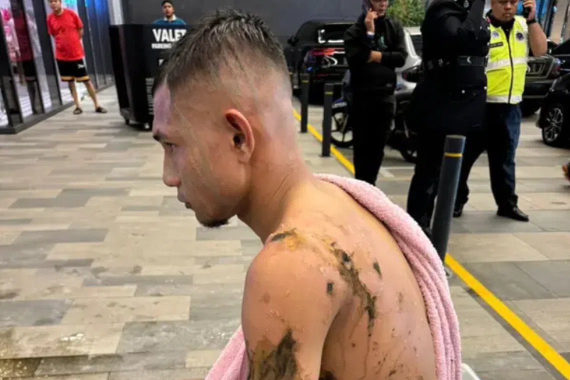 Malaysian national footballer Faisal Halim is now being treated for fourth-degree burns instead of second-degree burns he was previously diagnosed with. 