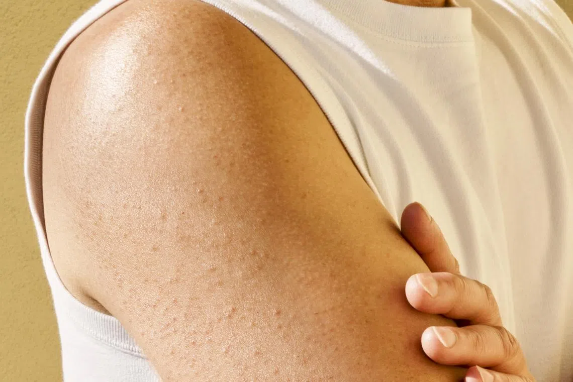 A person shows an arm with small, rough bumps in the skin, known as "chicken skin". Keratosis pilaris is a common skin condition. It is also easily treated at home.