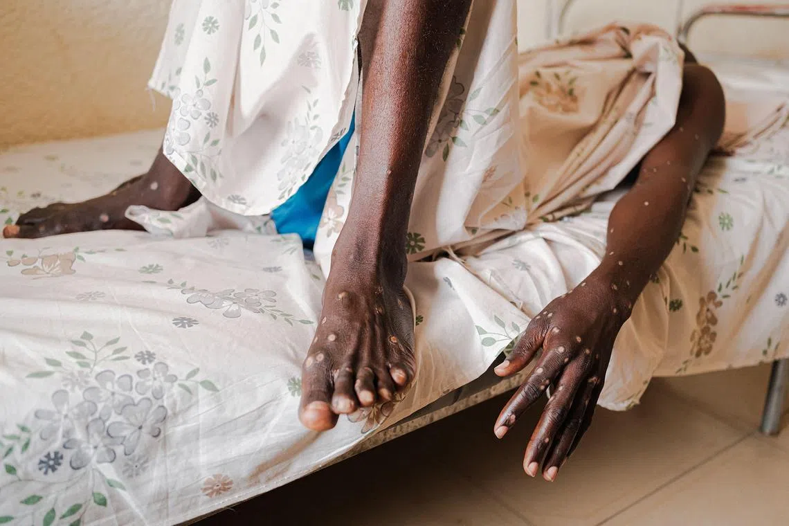 Cases of mpox are still increasing in several African countries, the Africa CDC says.