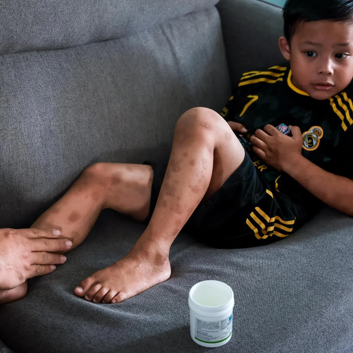 Faris Zafran, 5, who has severe eczema, having moisturiser applied on his legs by his father in their home in Pasir Ris on Dec 7, 2024.