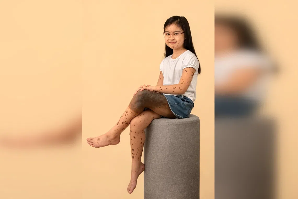 Charlotte Lim, 12, was born with giant congenital melanocytic nevus, a rare non-cancerous birthmark that covers a large portion of her body. The condition affects about 1 in 500,000 newborns.