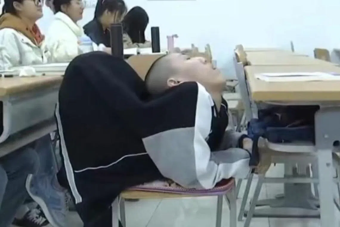 Mr Jiang Yanchen suffers from a type of arthritis that causes inflammation in the joints and ligaments of the spine. 