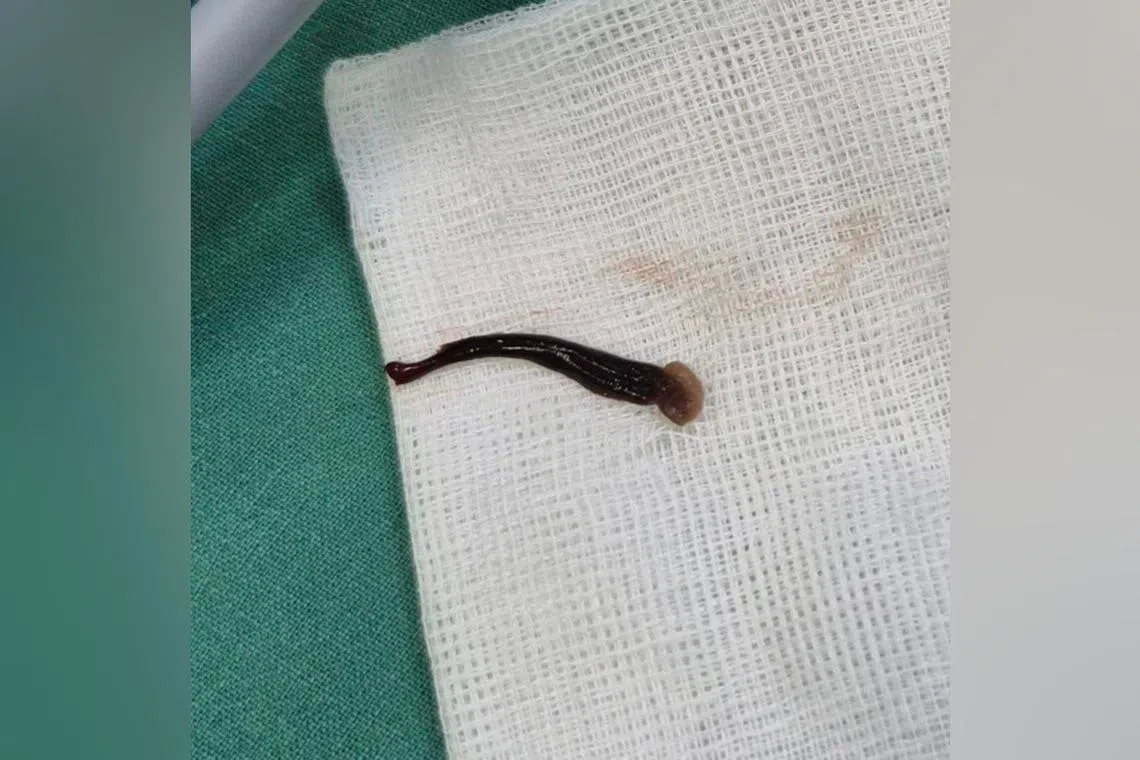 Doctors found the leech in the nostril of the three-year-old girl, who suffered repeated nosebleeds over four days.