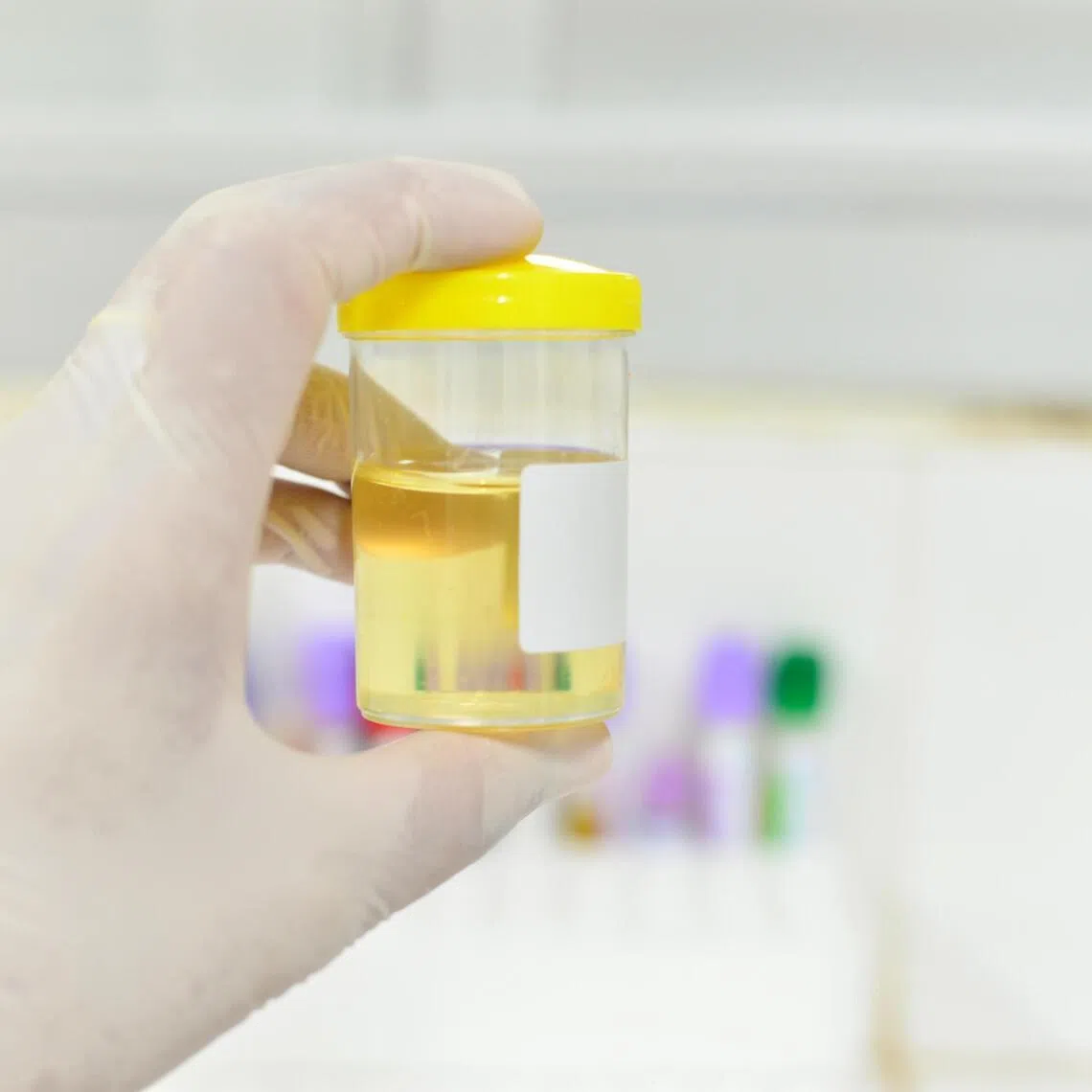 Using an emerging urine test on a sample like this can detect bladder, kidney and prostate cancer more accurately, a study found.