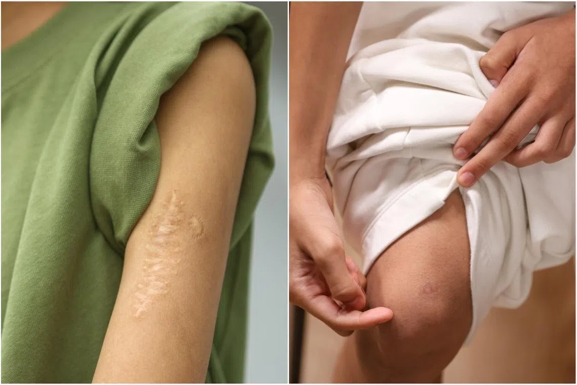 Nurshafira’s scars on her left arm and right knee.