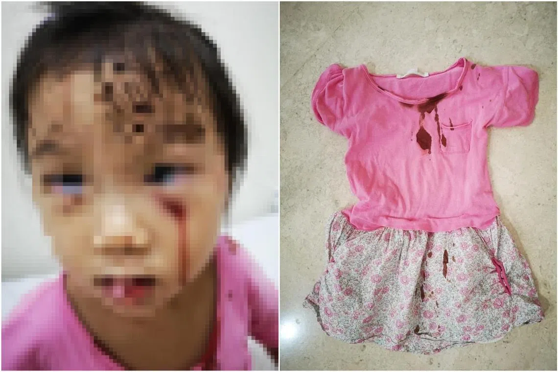 The girl suffered several cuts to her face and had to be put under general anaesthesia in order for the wound to be stitched up.