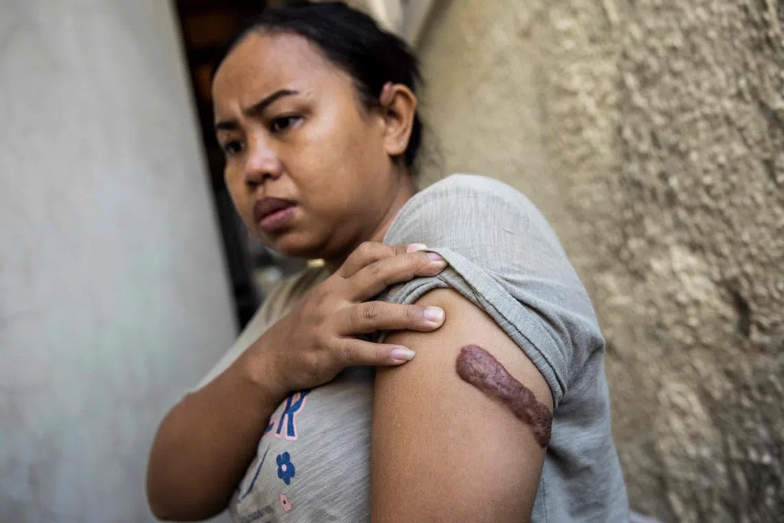 Ms Kartika Puspitasari showing a scar from an injury inflicted by her previous employers, in Hong Kong on Oct 7, 2022.