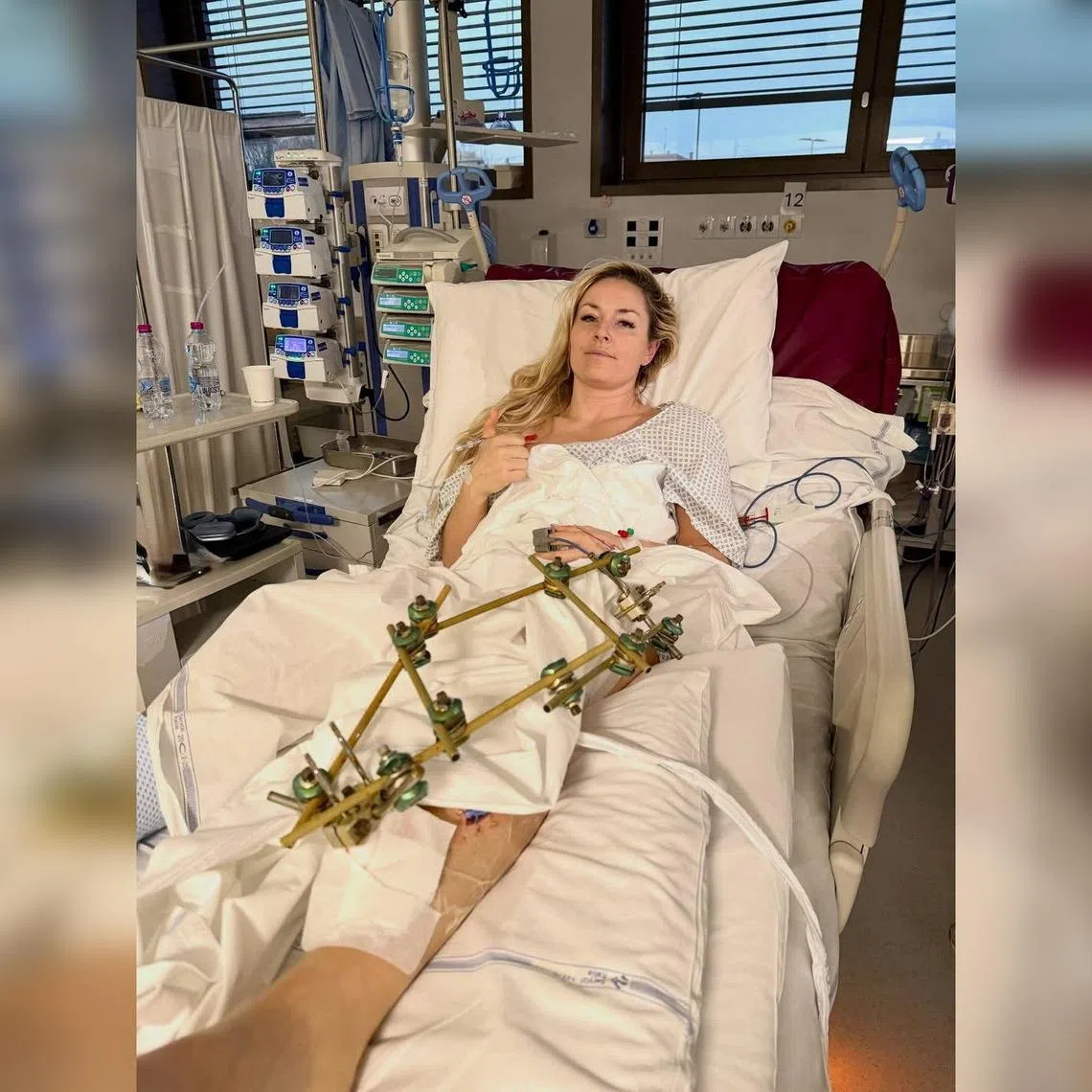 Lindsey Vonn suffered multiple fractures in her left leg after a high-speed fall during the Olympic downhill in Cortina on Feb 8.