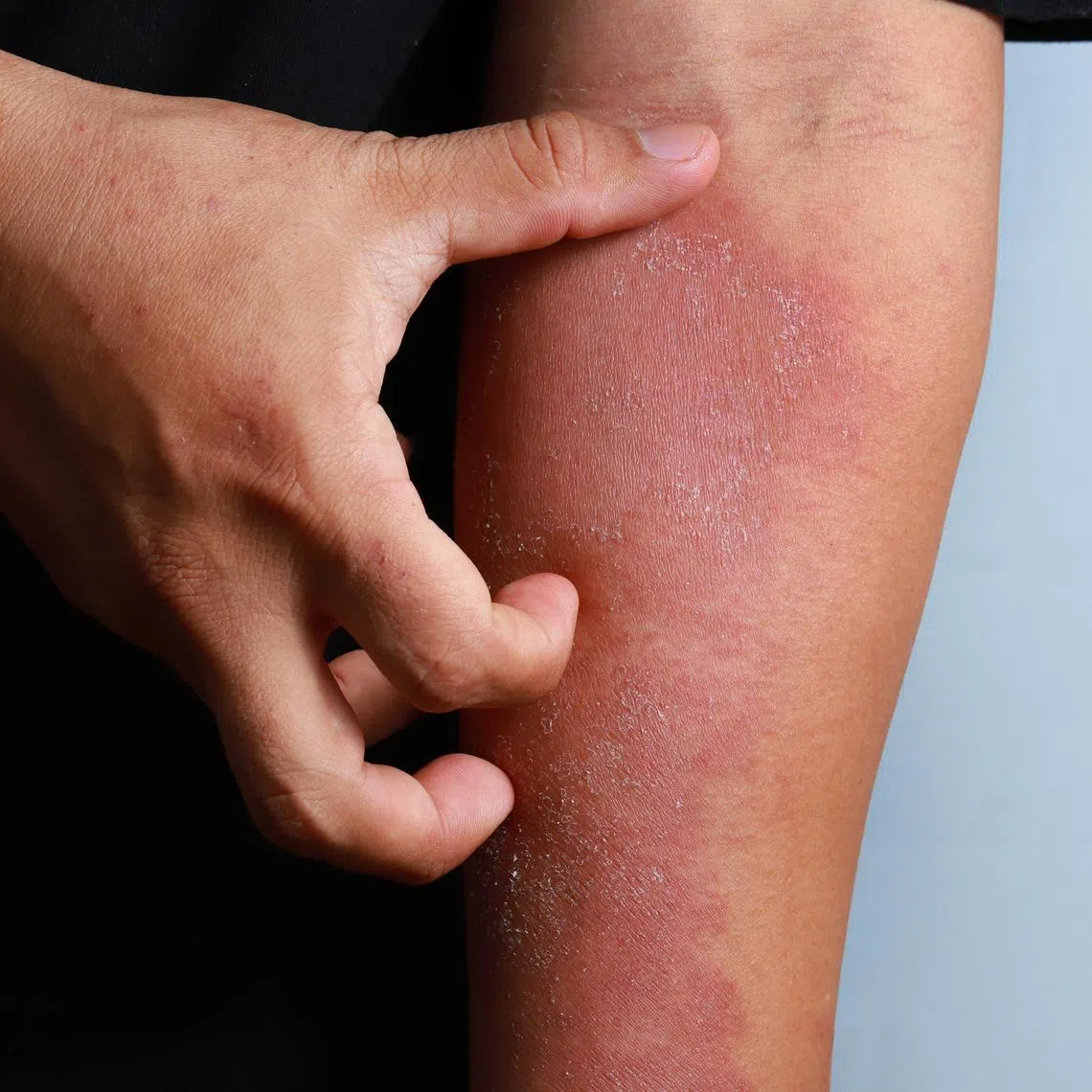 Visible skin conditions can cause deep mental distress, especially among young patients, says the writer.
