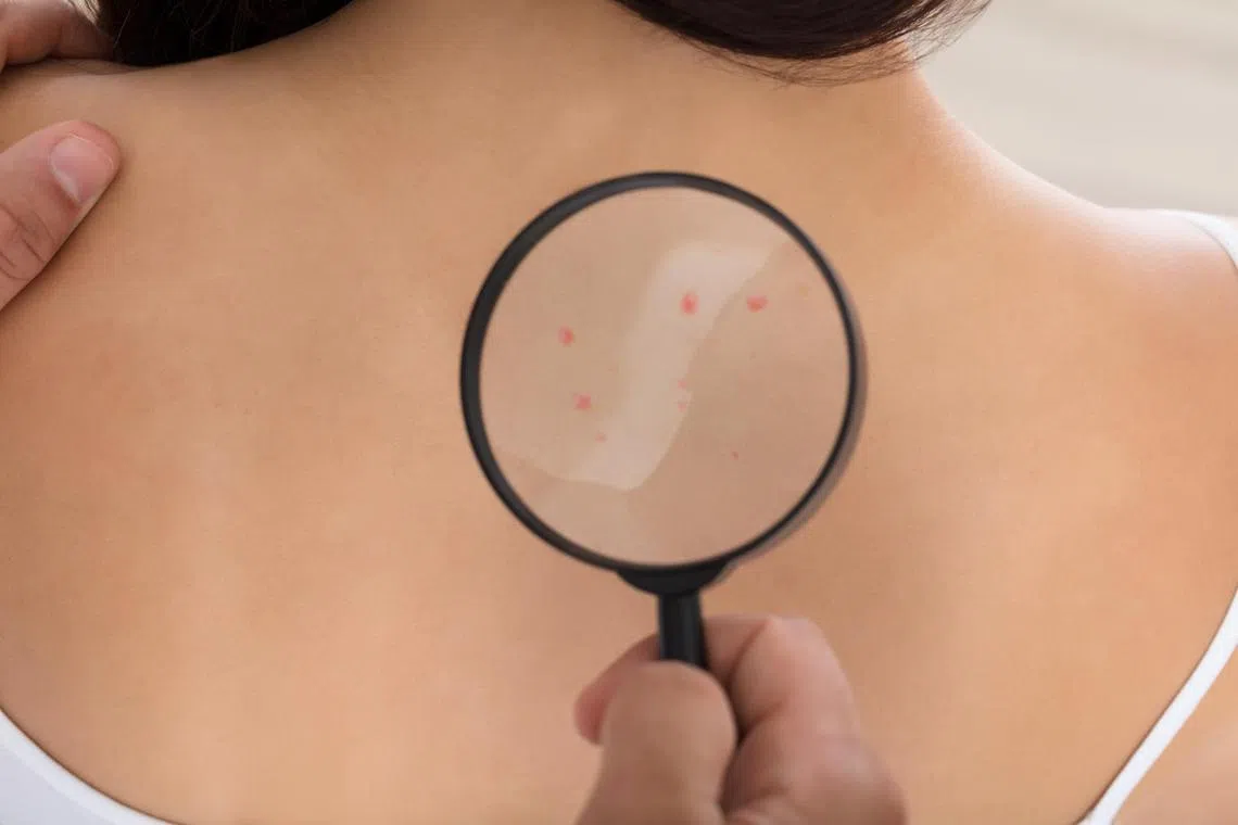 Some 8,000 people are expected to die from melanoma in 2022.