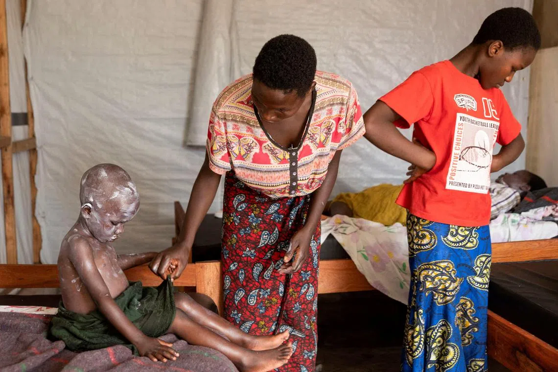 A woman applies medicine to the skin of her child, who is undergoing treatment for Mpox, an infectious disease caused by the Mpox virus that causes a painful rash, enlarged lymph nodes and fever, in Munigi, Nyiragongo territory, near Goma in North Kivu province of the Democratic Republic of Congo August 19, 2024. REUTERS/Arlette Bashizi/File Photo