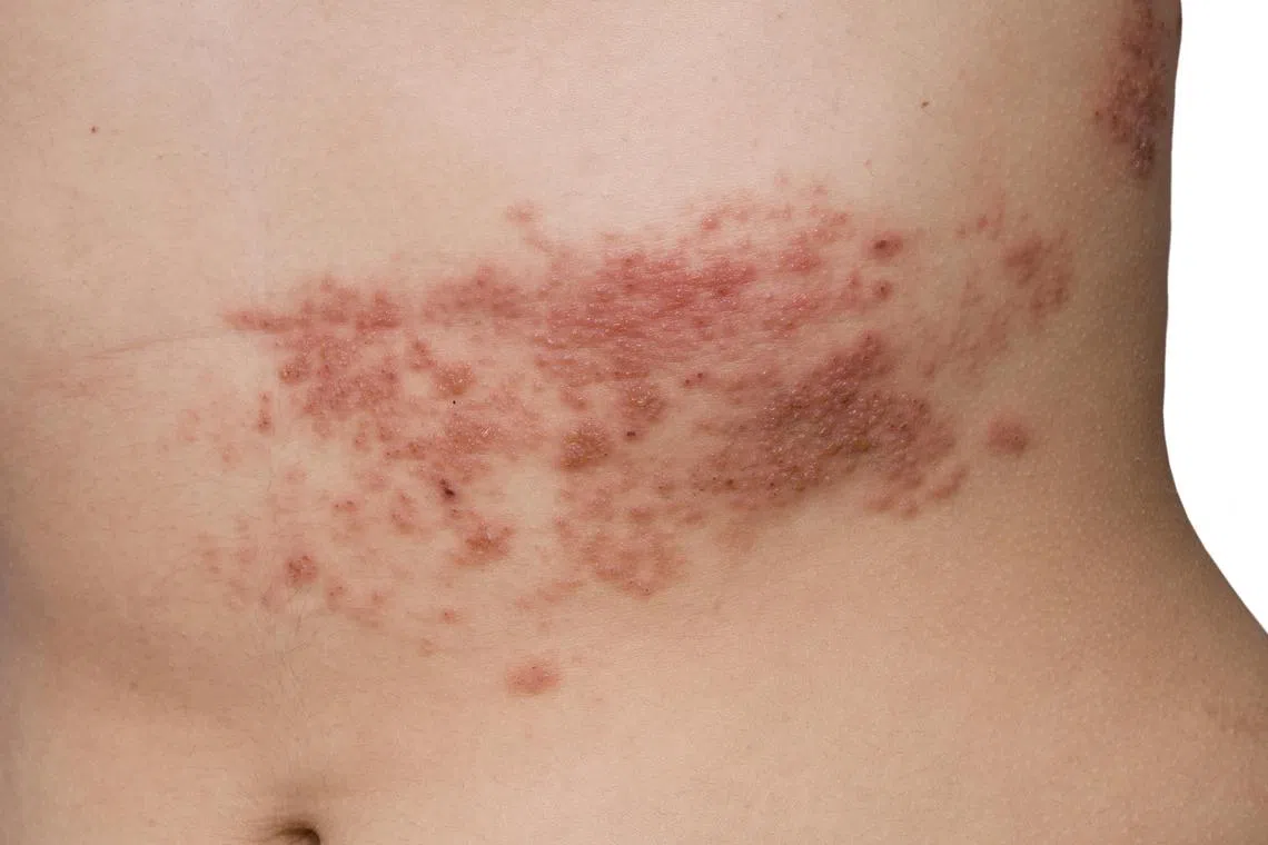 While shingles may not be life-threatening, it is usually a very painful infection that can last for weeks.