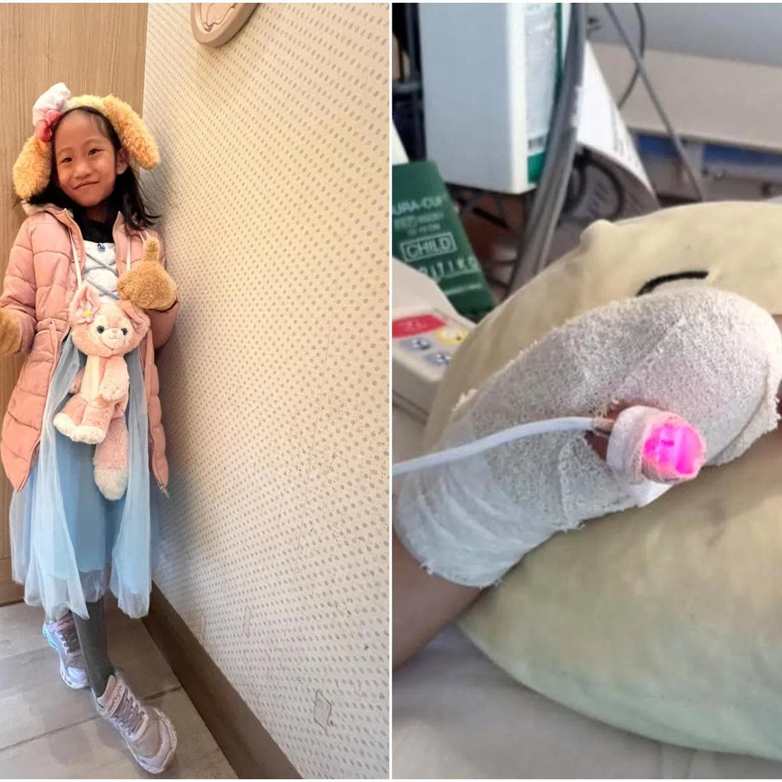 In 2021, Kara Chia's index finger was severed (right) after a hand dryer at ION Orchard's toilet crushed it. 