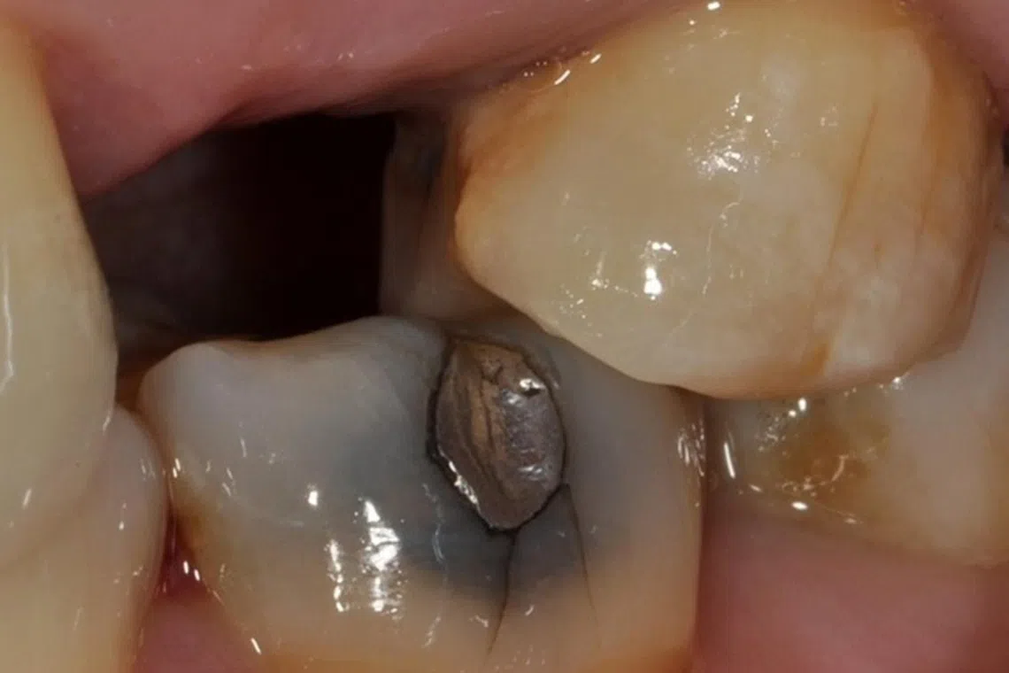 The photo shows a tooth with a mercury filling.