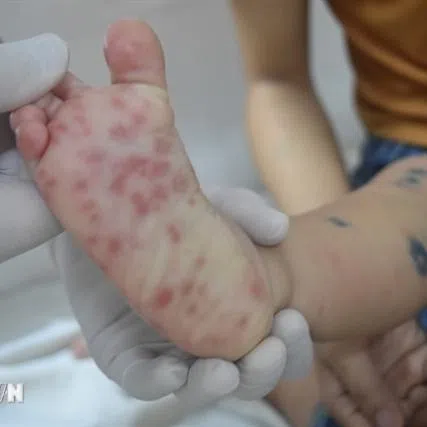 Nearly 7,300 cases have been reported in Ho Chi Minh City since the beginning of the year.