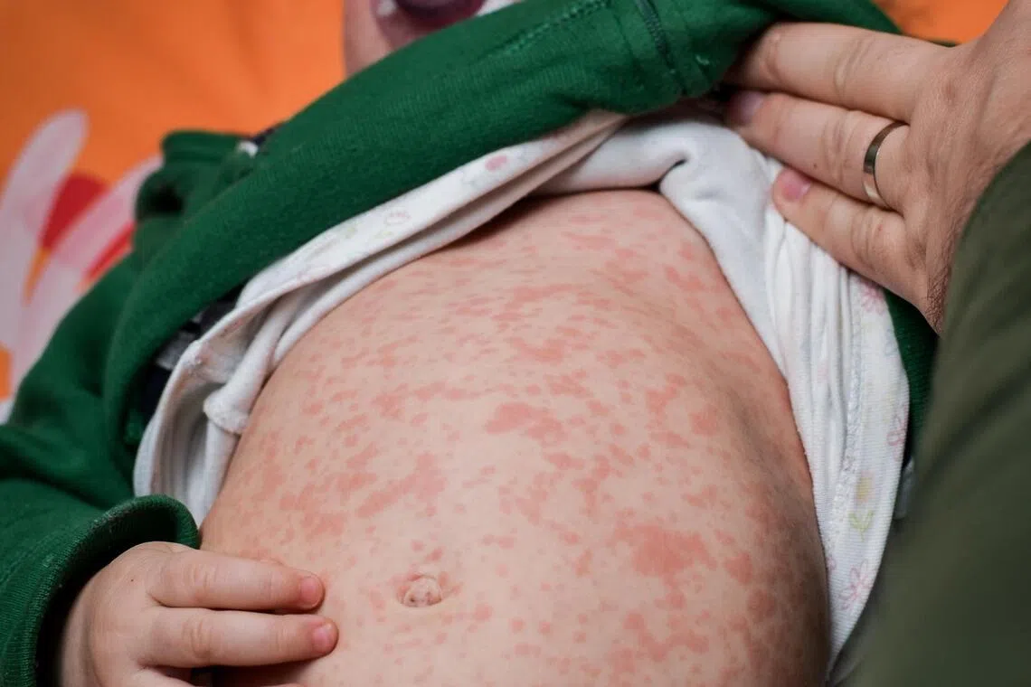 Babies travelling to countries with high measles incidence need to get MMR vaccine early: Ong Ye Kung