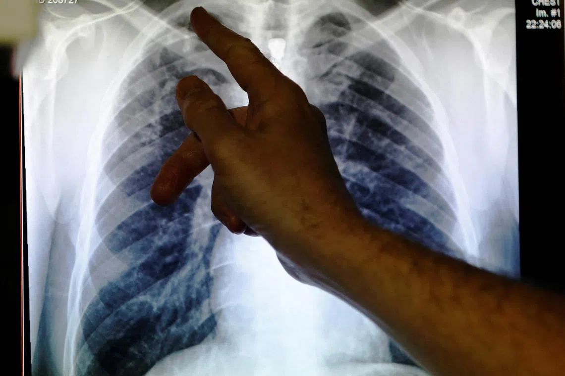 Disruptions, linked to Covid-19, are estimated to have resulted in nearly half a million excess tuberculosis deaths between 2020 and 2022.