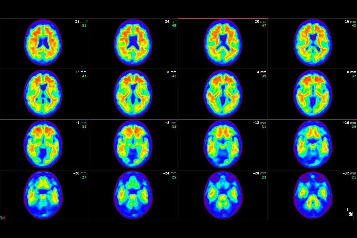 In an undated image provided by Eli Lilly, brain scans from a patient in the clinical trials of donanemab show amyloid plaque being removed from the patientÕs brain. The drug, Kisunla, made by Eli Lilly, is the latest in a new class of treatments that could modestly slow cognitive decline in initial stages of the disease but also carry safety risks. (Eli Lilly via The New York Times) Ñ NO SALES; FOR EDITORIAL USE ONLY WITH NYT STORY ALZHEIMERS DRUG BY PAM BELLUCK FOR JULY 2, 2024. ALL OTHER USE PROHIBITED. Ñ