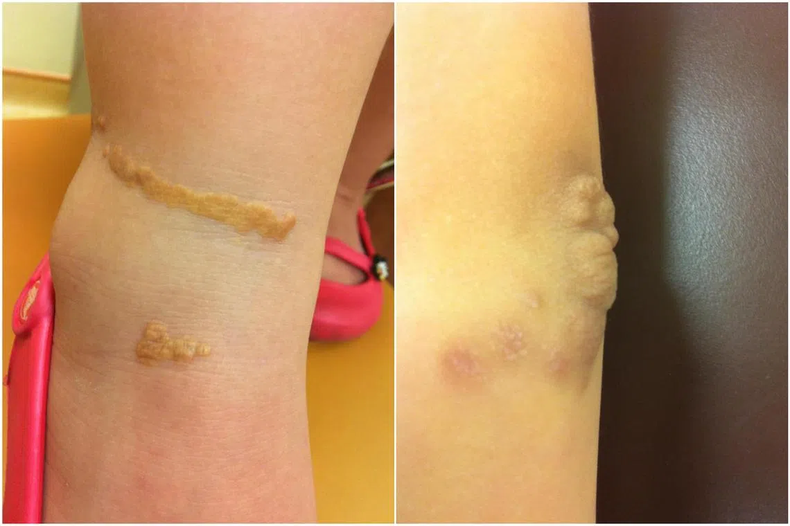 KKH sees fivefold rise in children with genetic disease that may lead to early heart attack, stroke