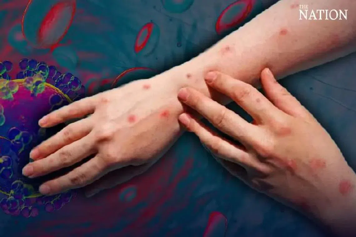 The infection had spread to his lungs and brain and he had a low CD4 count of only 16.