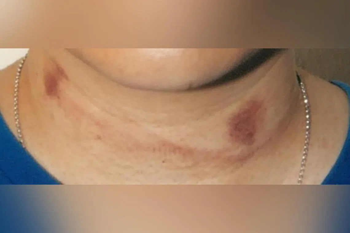 The accused claimed that the bruises on the woman's neck were "love bites". But the Court of Appeal said he was not able to explain the line between the bruises which indicated that some injury was inflicted.