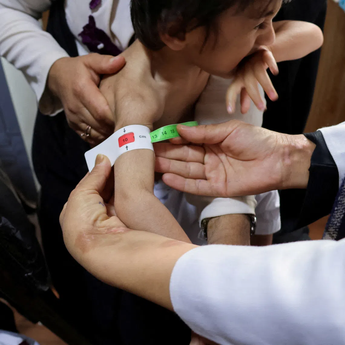 FILE PHOTO: A doctor measures the upper arm of a three-year-old boy suffering from severe acute malnutrition, at Yaka Dokan health clinic, Herat, Afghanistan, October 23, 2024. REUTERS/Charlotte Greenfield/File Photo