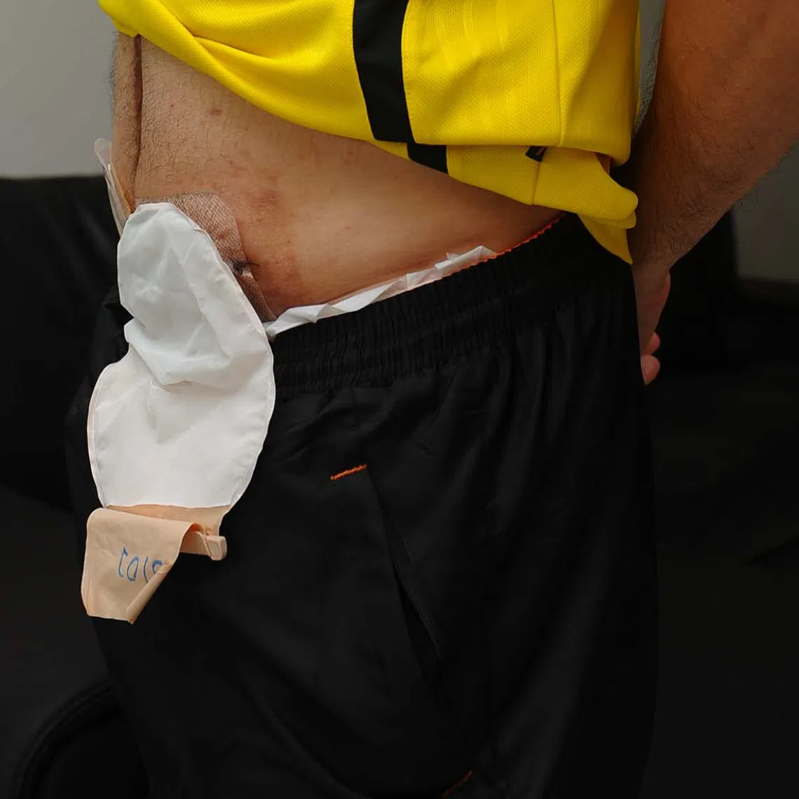 Moving forward, we need ro talk more openly about stomas to help patients feel less isolated, writes a nurse.