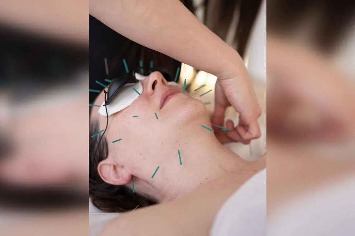 A facial acupuncture session at Gotham Wellness in New York in March. Cosmetic acupuncture uses needles about one-fifth the diameter of typical hypodermic needles, and is said to increase circulation and improve skin tone. 