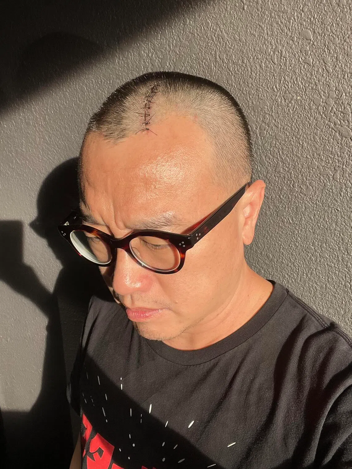 Doctors found a blood clot in Larry Peh’s brain when he was doing National Service.