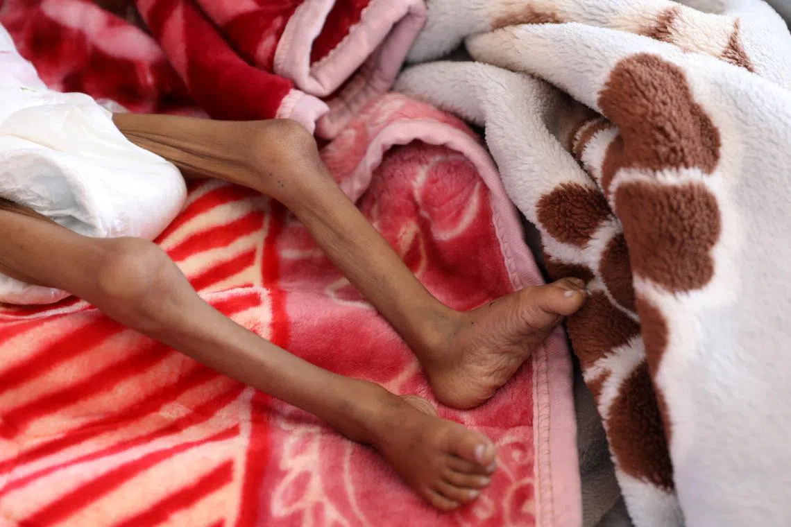 FILE PHOTO: A malnourished girl lies on a bed at the malnutrition treatment ward of al-Sabeen hospital in Sanaa, Yemen October 27, 2020. REUTERS/Khaled Abdullah/File Photo