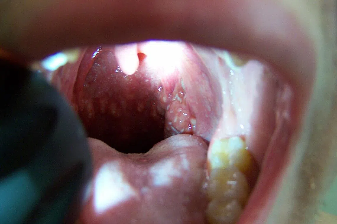 Herpangina is an infectious condition where one develops blisters and ulcers in the mouth.