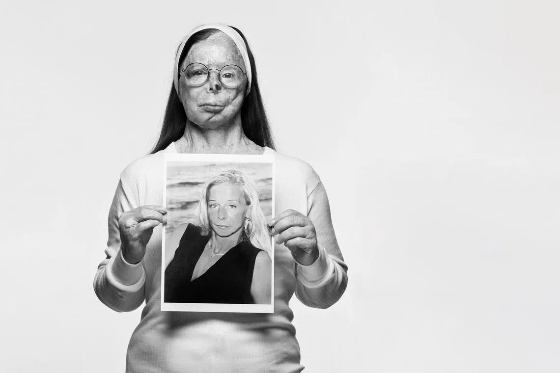 Acid attack survivor and campaigner Patricia Lefranc holds a photo of herself before the devastating 2009 attack by an ex.