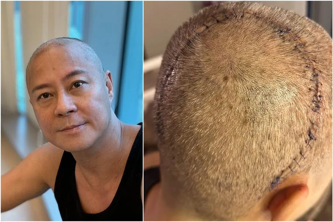 Remus Choy announced in an Instagram post that he is recovering after undergoing surgery to remove a brain tumour.