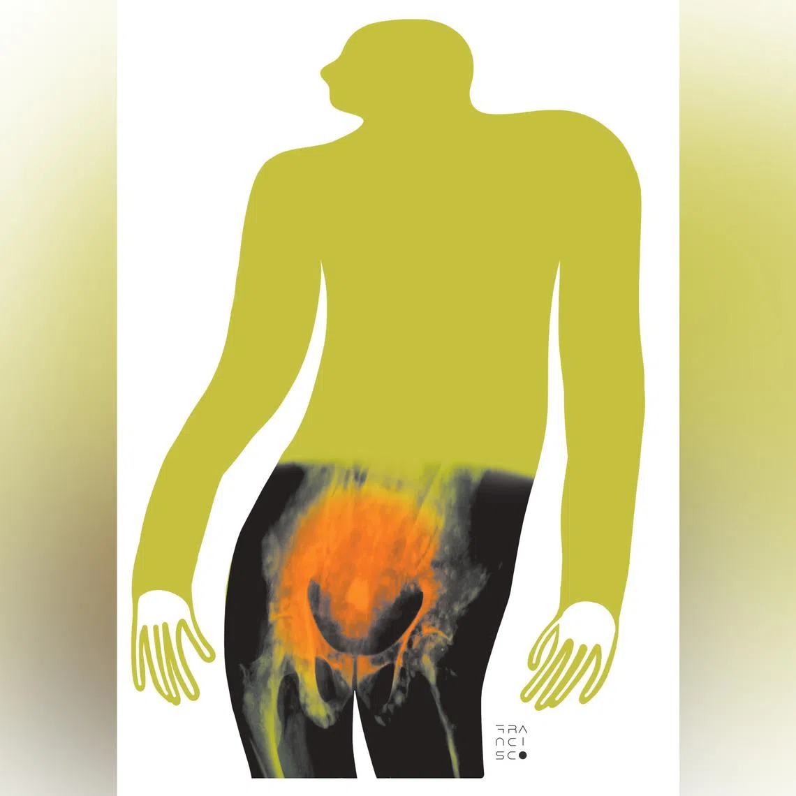 Smoking and obesity are associated with increased risk of several cancers and prostate cancer is no exception. 