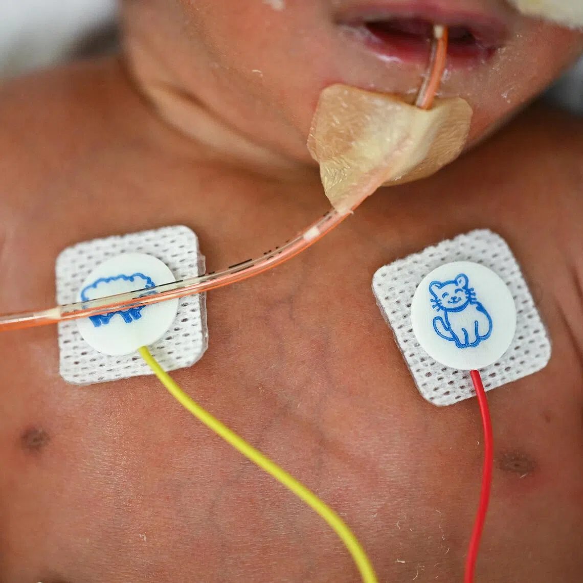 The women have to deliver by the 35th week of pregnancy at the latest, which means the babies are born premature.