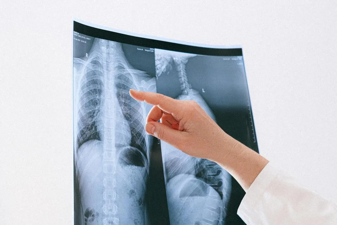 Based on a study by the National Cancer Centre Singapore, almost half the lung cancer patients here have never smoked in their lives.