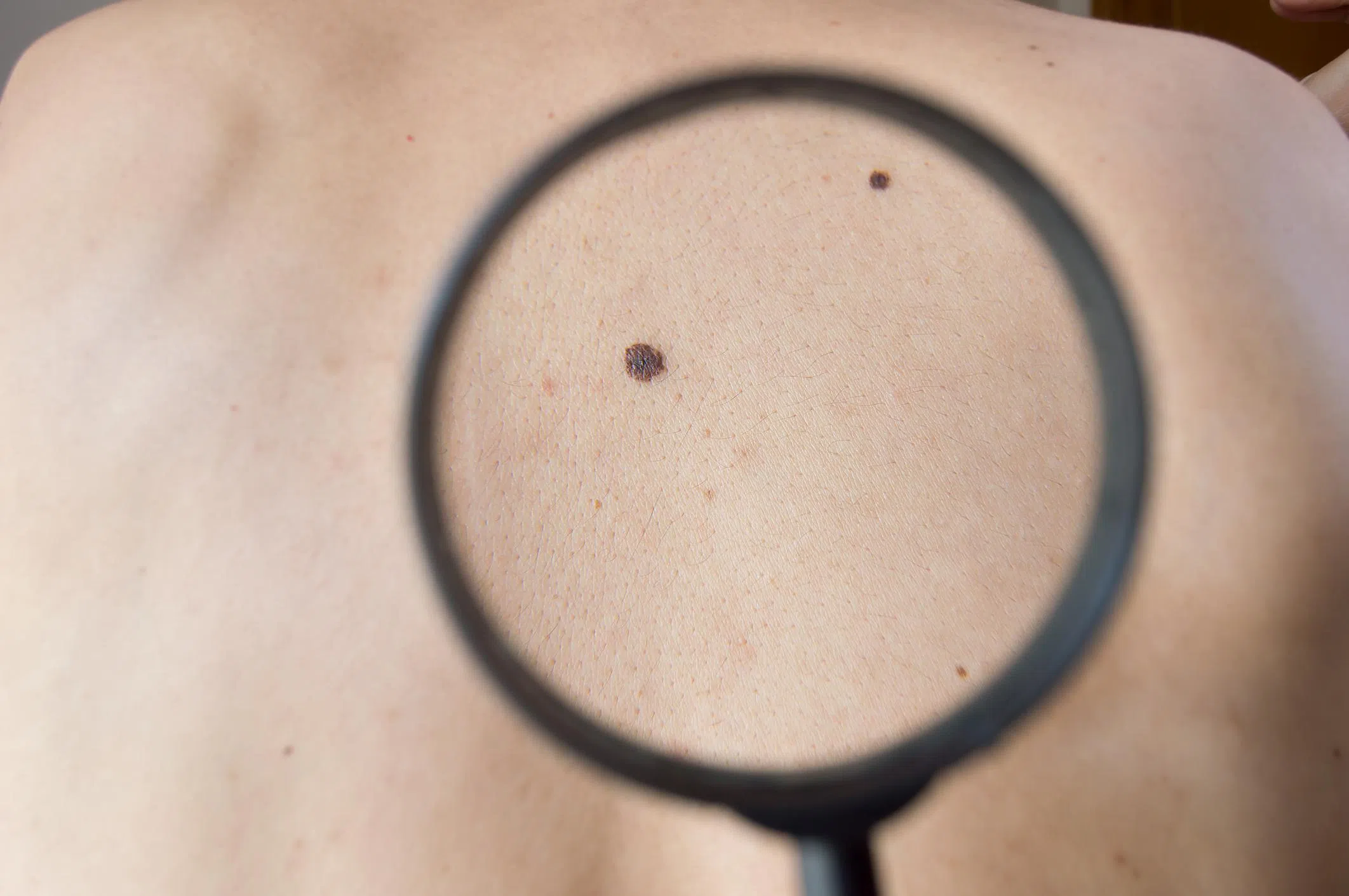 examining melanoma on a back of man with magnifying glass.