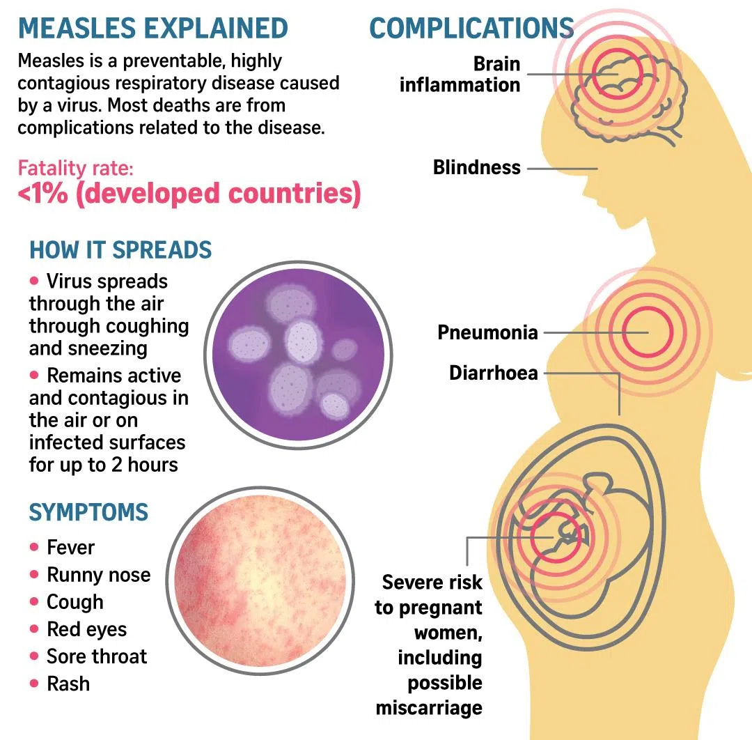 Graphic on measles symptoms.