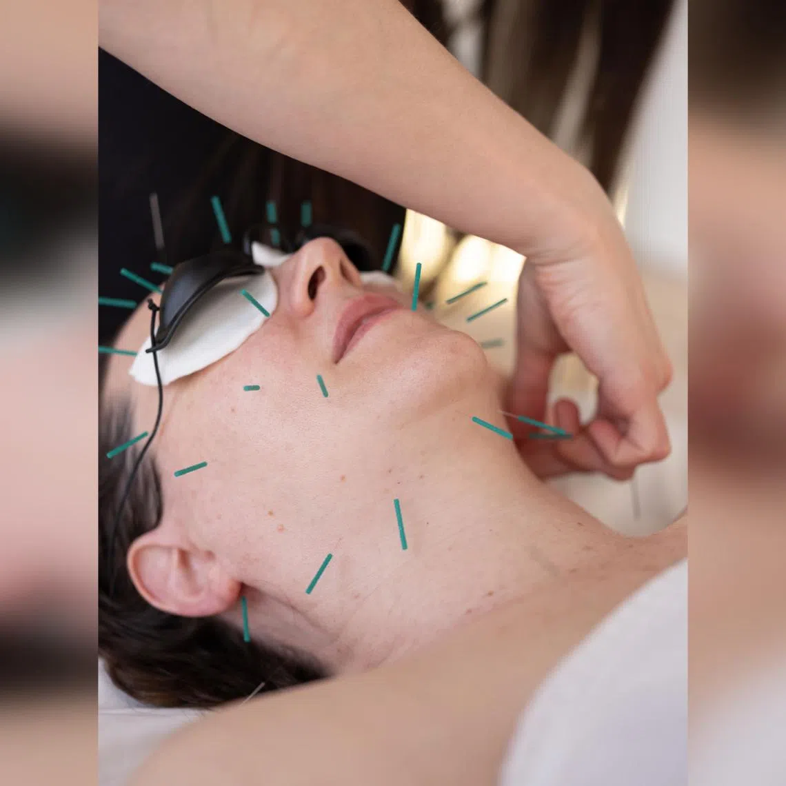 A facial acupuncture session at Gotham Wellness in New York in March. Cosmetic acupuncture uses needles about one-fifth the diameter of typical hypodermic needles, and is said to increase circulation and improve skin tone. 