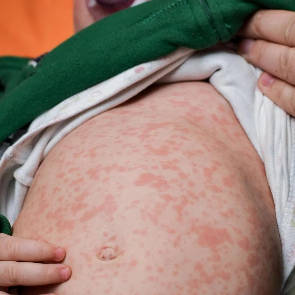 The measles virus is spread through air droplets and direct contact with nasal and throat secretions.